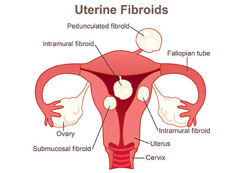 Fibroids Relief Herbal Blend