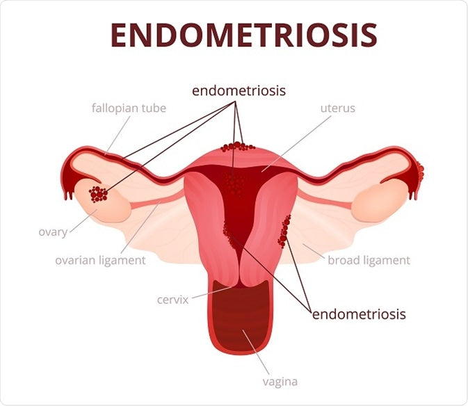 Endometriosis Herbal Blend